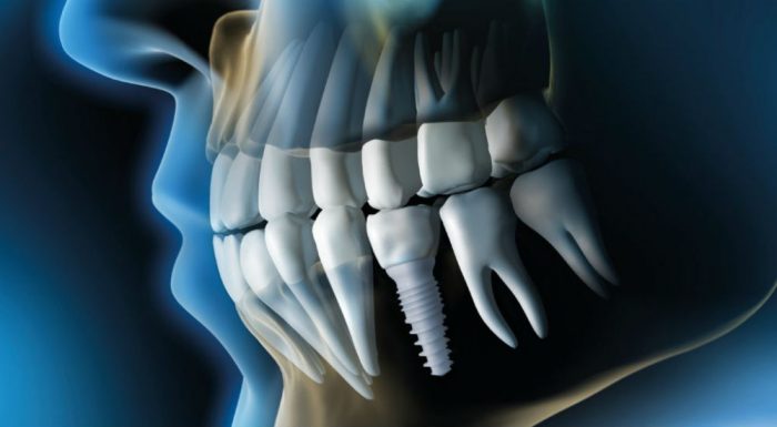 Dental Implant Technology