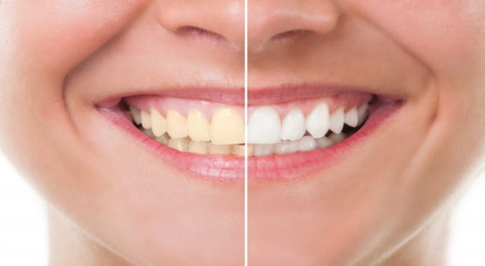 What You Can And Cannot Control If You Suffer From Tooth Discolouration